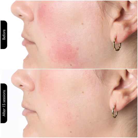 Silk'n Facial LED Mask 100 LEDS